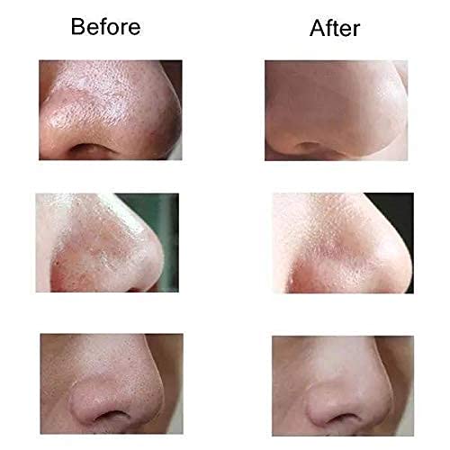 Blackhead Cosmetology Apparatus