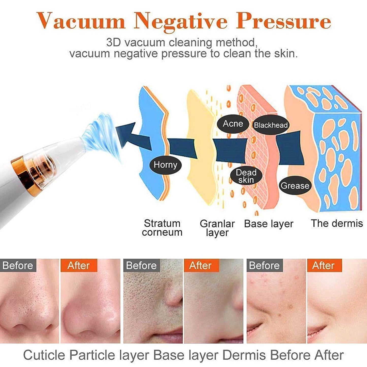 Multi-Functional Blackhead Remover