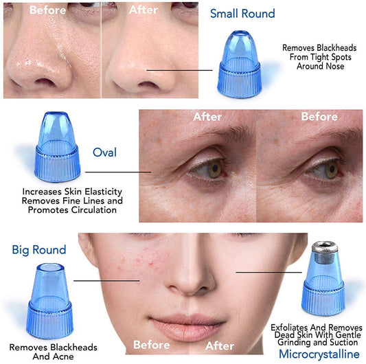 Blackhead Cosmetology Apparatus